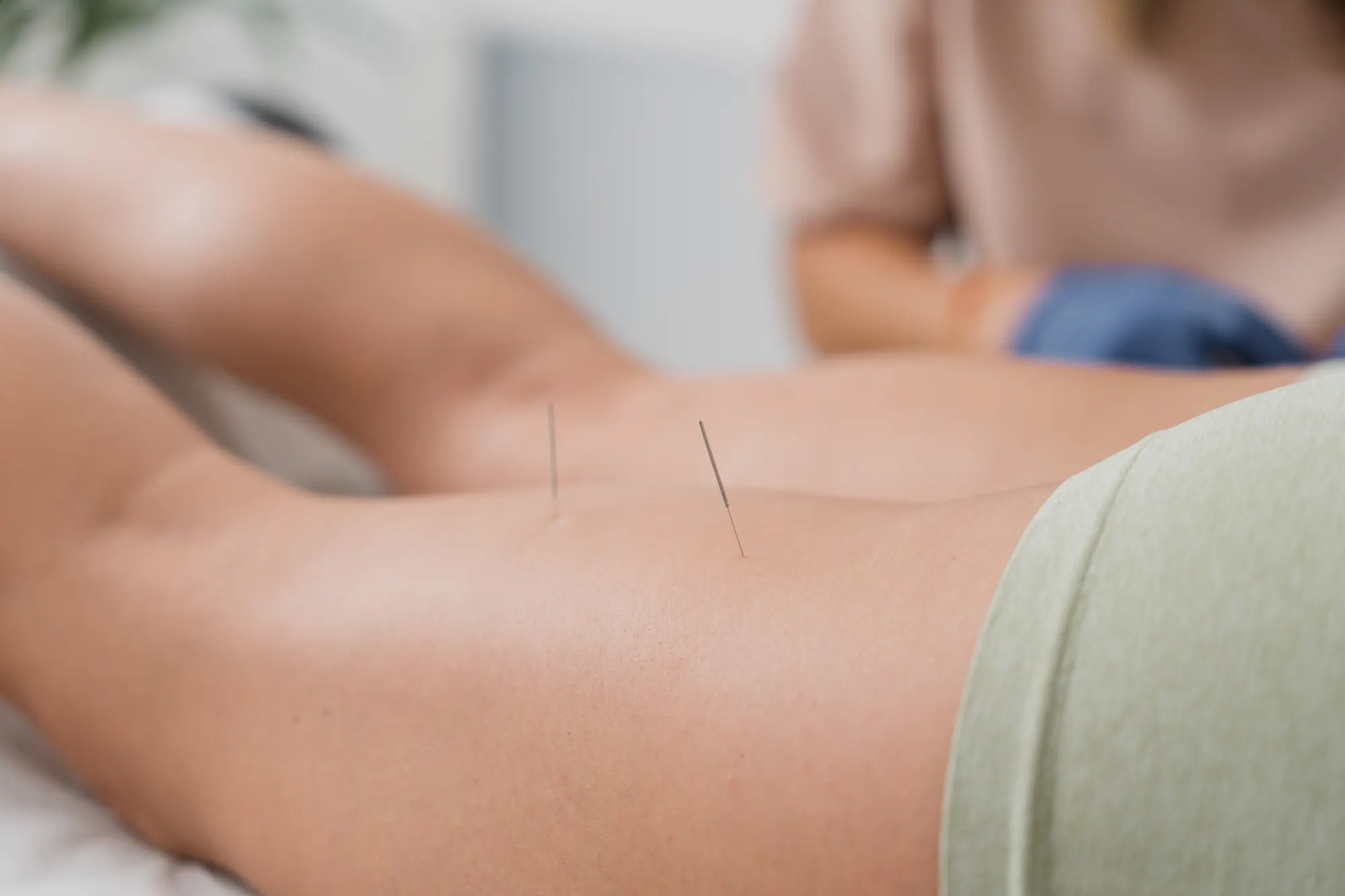 Person undergoing dry needling therapy